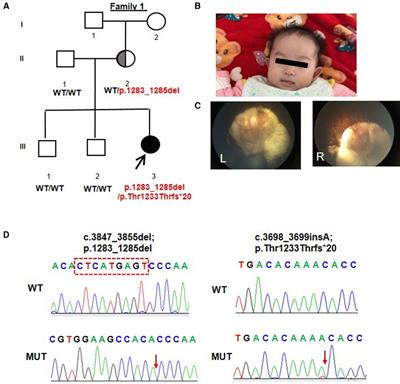 Case report: Expansion of phenotypic and genotypic data in TENM3-related syndrome: Report of two cases